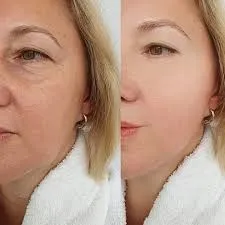 Ellansé y la nueva estética consciente: volumen, tiempo y criterio clínico